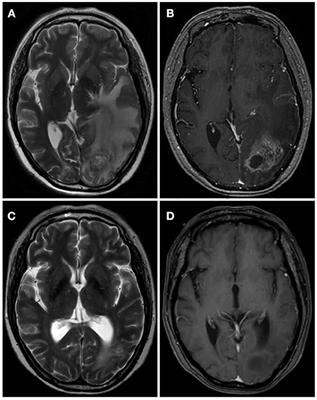 Low-Dosage Bevacizumab Treatment: Effect on Radiation Necrosis After Gamma Knife Radiosurgery for Brain Metastases